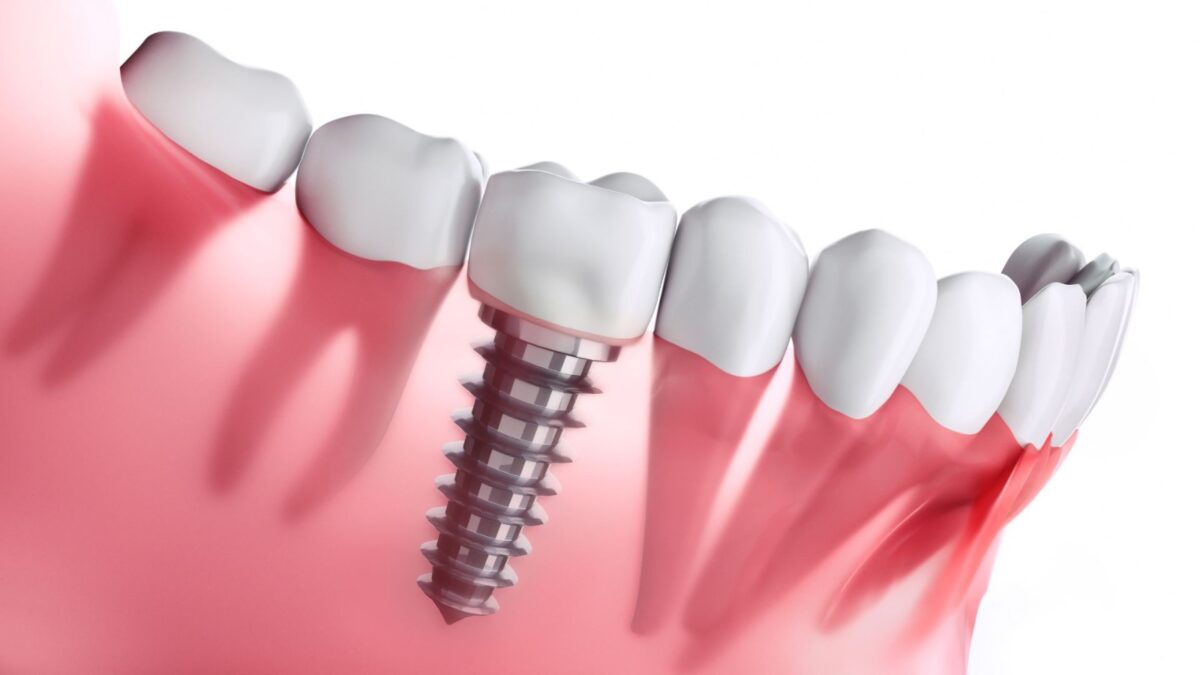 Dental Implants